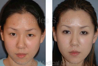 Blepharoplasty before 427506