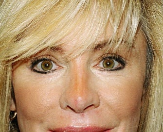 eyelid procedure after 380413