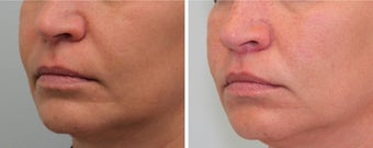 Bullhorn Lip Lift after 590751