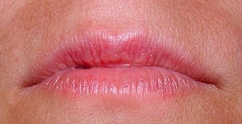 Lip enhancement before 374296
