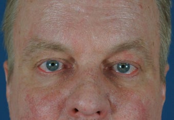 Man in 50's seek non-surgical facial rejuvention after 634493