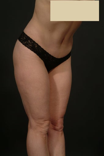 Tummy tuck with hip liposuction after 163112