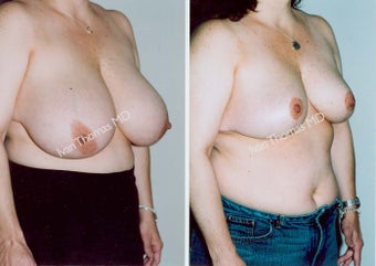 Breast Reduction before 243745