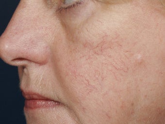 Yag laser before 140105