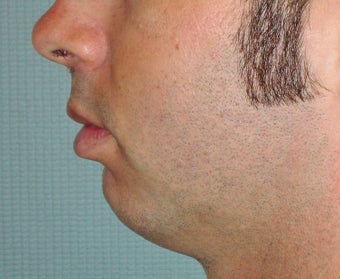 Chin Augmentation before 365432