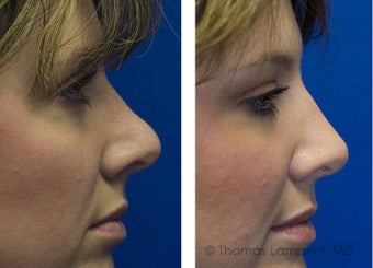 Revision Rhinoplasty after 234401