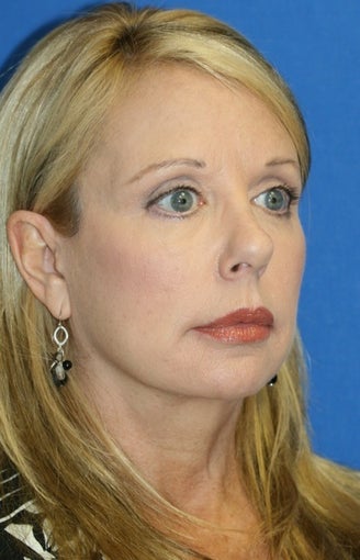 Facelift, Necklift, Fat Transfer, Upper Bleph., Lower Eyelid Skin Pinch after 392453