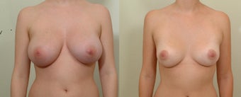 Breast Reduction before 106762