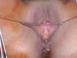 Labia Reduction Surgery (Labiaplasty) before 146543