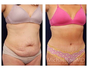 Tummy Tuck with Liposuction after 391594