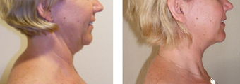 Neck Lift before 229643