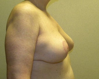 Breast Lift 411125