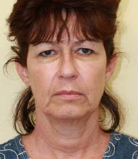 Face and Necklift, Eyelids, Temporal Browlift before 232351