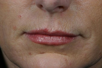 Botox before 309235