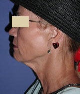 Neck Lift Surgery before 124955