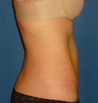 Mini-Abdominoplasty with VASER liposuction after 384685