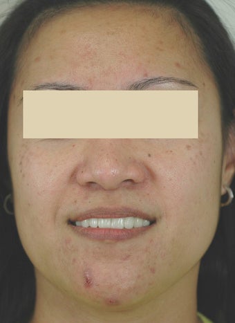 Laser Acne Treatment before 87987