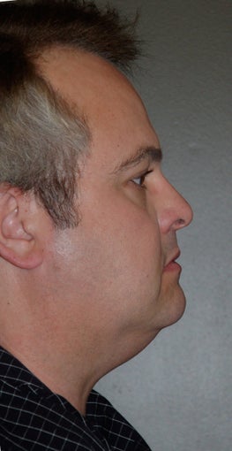Chin Augementation before 273279