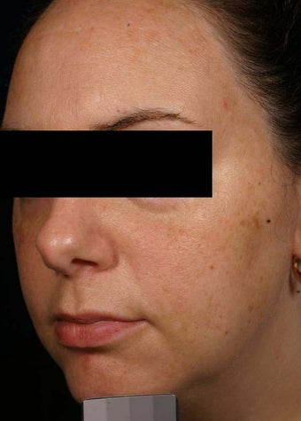 Melasma before 136699