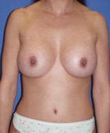 Abdominoplasty and Breast Augmentation Surgery after 124861