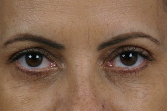 Restylane before 309257