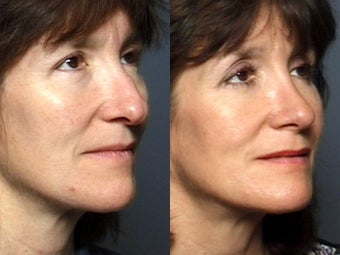 Rhinoplasty after 339184