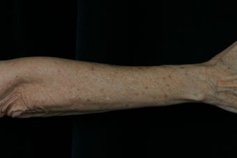 Dual Fraxel Laser before 309244