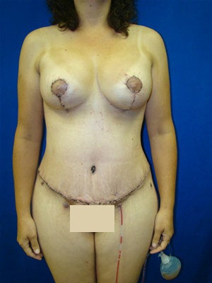Extended Tummy Tuck, Liposuction, Breast Lift, Breast Augmentation Surgery after 120811