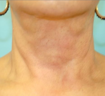 Exilis after 424064
