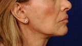 Before and After Lip Augmentation after 66156
