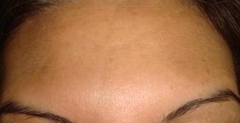 botox injections after 263054