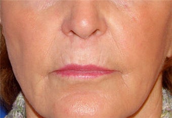 Juvederm for Lip Border and Lip Lines before 123684