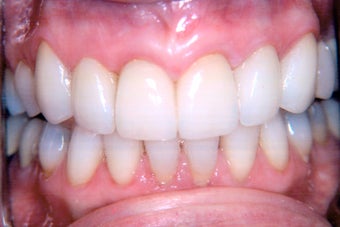 Combination of crowns, veneers, and gum surgery after 240558