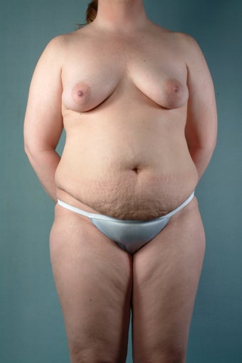 Breast Augmentation/Tummy Tuck/Liposuction before 241581