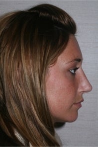 Rhinoplasty after 442949