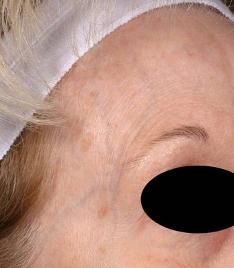 Blue veins around eyes before 135044