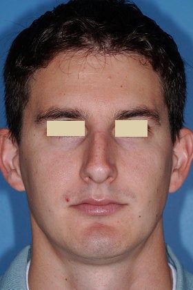 Rhinoplasty before 154298