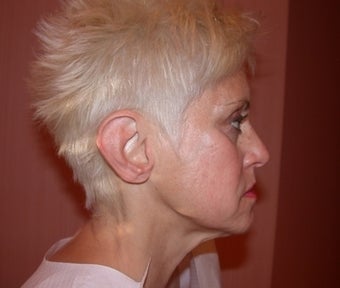 Facelift, Neck Lift, Juvaderm before 191643