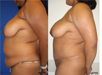 Abdominoplasty (tummy tuck), Flank Liposuction 328417
