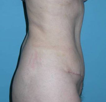 Tummy tuck after 111941