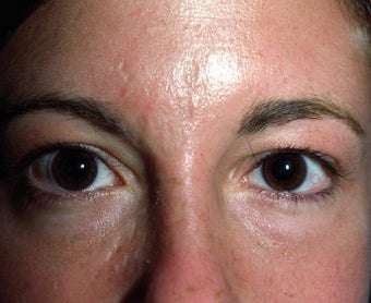 Liquid Injectable Silicone after 417387