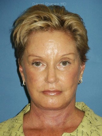 Facelift, Endoscopic Browlift, Upper and Lower Blepharoplasty with canthopexy, Fat injections to the Lips, Perioral Dermabrasion after 248918