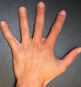 Hand rejuvenation before 374249