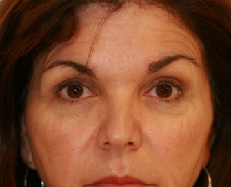 Lower eyelid blepharoplasty before 378926