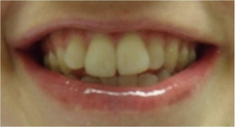 Zoom! Laser Whitening before 326054
