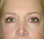 Fat transfer and Skin resurfacing after 84439