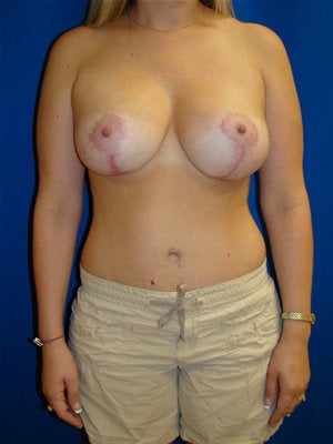 Breast Augmentation Surgery with Breast Lift after 123607