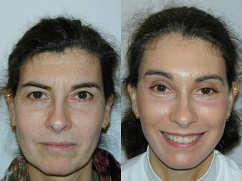 Full Facelift - Browlift, upper and lower blepharoplasty, Lower Facelift before 139168