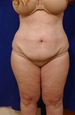 Abdominoplasty with liposculpture before 59762