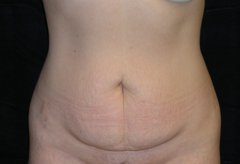 Abdominoplasty before 476707